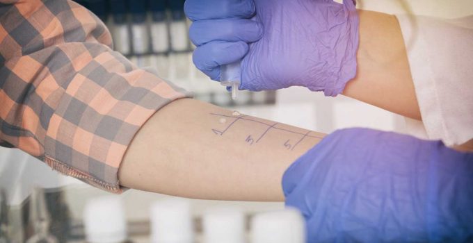 8 Things You Need To Know About DIY Allergy Testing