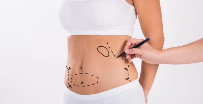 5 Things You Should Avoid Doing bBefore Liposuction