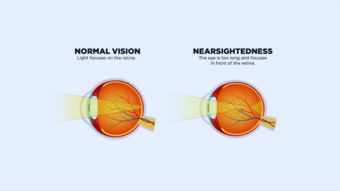 is LASIK only for correcting nearsightedness