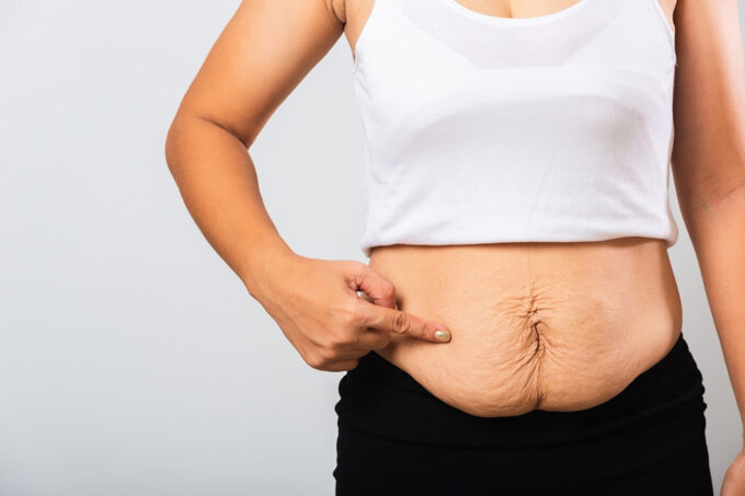 What to do after gastric sleeve